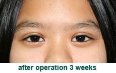 plastic-surgery-blepharoplasty